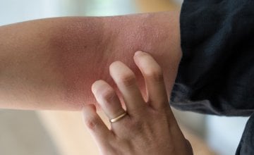 atopijski dermatitis pogađa milijune djece i odraslih