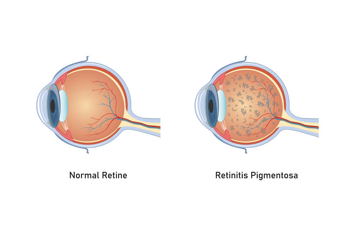 genska terapija za retinitis pigmentosu