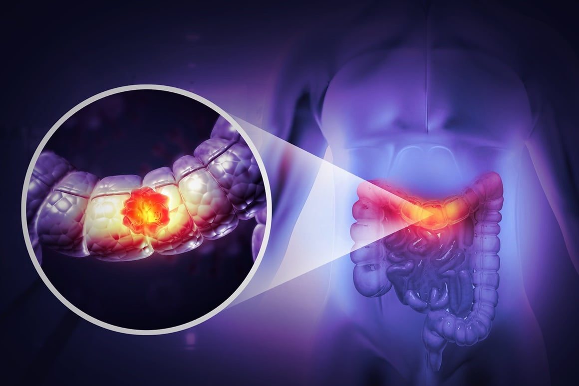 incidencija kolorektalnog karcinoma stalno raste