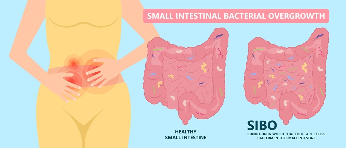 SIBO uključuje prekomjerni rast bakterija u crijevima