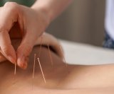 Akupunktura može pomoći kod tegobe koja zahvaća 80 % ljudi