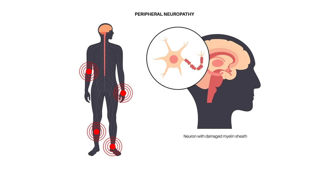 Vrste neuropatske boli