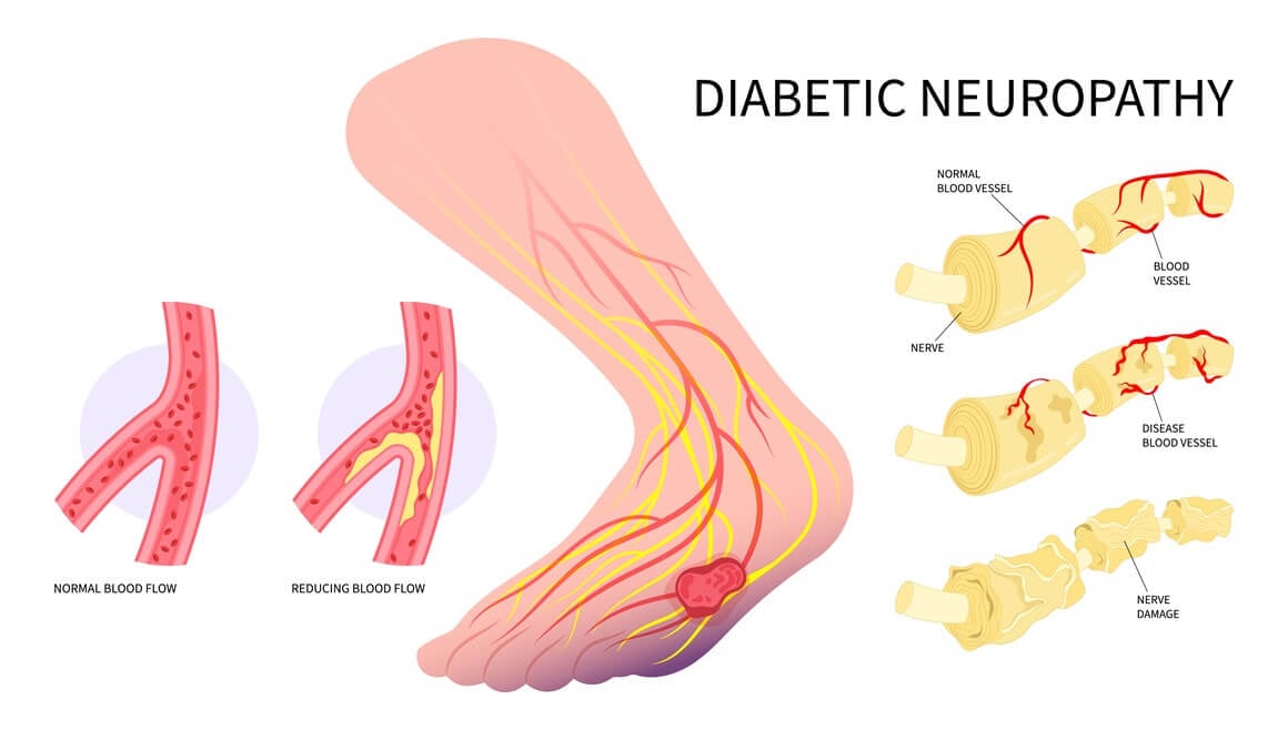 Dijabetička neuropatija - simptomi