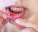 Aftozni čirevi ili rak usne šupljine Ovo su razlike