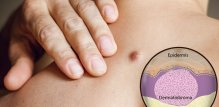 Dermatofibromi su benigne kožne izrasline koje su češće kod odraslih