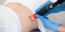 Laserska terapija, posebno terapija pulsnim žutim laserom, može biti vrlo učinkovita za veće keloide