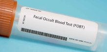 Testovi stolice mogu biti dobra alternativa kolonoskopiji