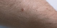 dermatofibrom