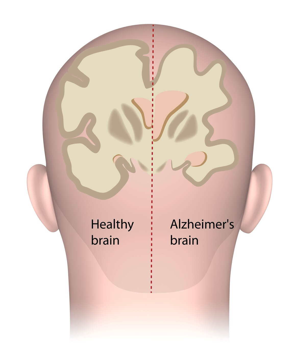 mozak s Alzheimerovom bolešću