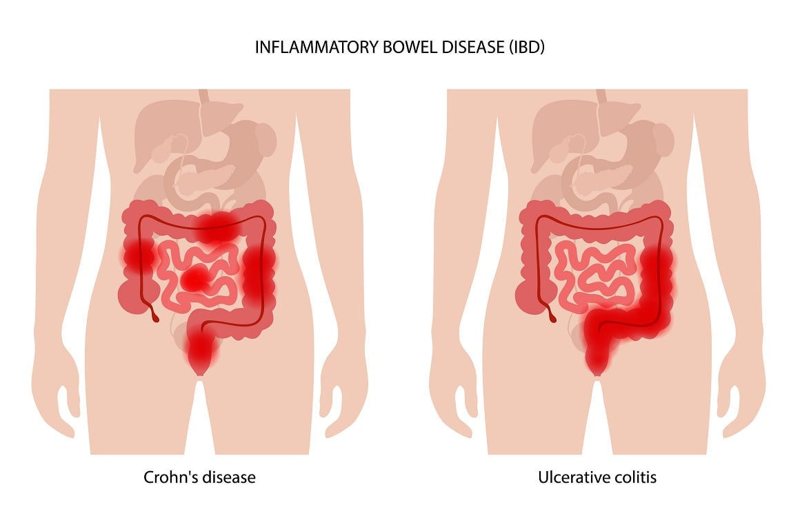 što razlikuje IBD i IBS