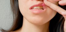 Aftozni stomatitis