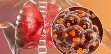 MRSA infekcija
