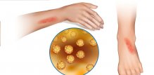 MRSA - simptomi