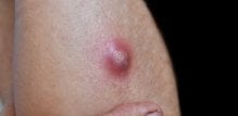Najčešći uzrok karbunkula je bakterija Staphylococcus aureus