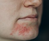 Rozaceja, psorijaza i ekcem imaju neke zajedničke simptome