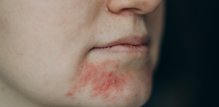 Rozaceja, psorijaza i ekcem imaju neke zajedničke simptome