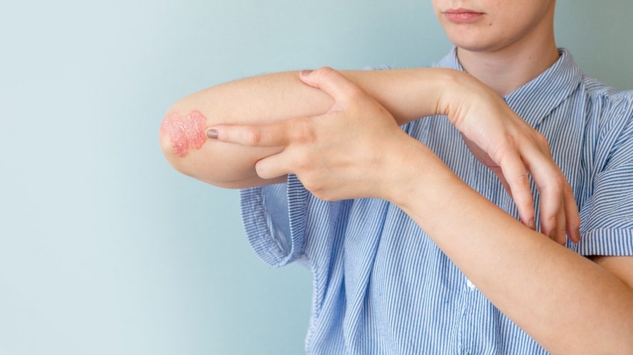S porastom temperature i vlage simptomi psorijaze mogu se poboljšati