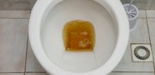 Urin crvene, smeđe ili tamno jantarne boje može biti znak zatajenja bubrega
