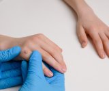 Dovoljan je samo jedan dodir Evo koliko je zarazna obična bradavica
