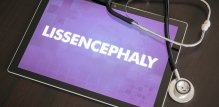 Lisencefalija - dijagnostika