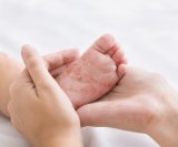 Pad procijepljenosti Prijeti li nova epidemija ospica