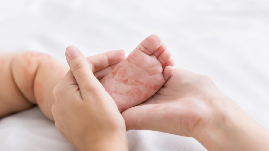 Pad procijepljenosti Prijeti li nova epidemija ospica