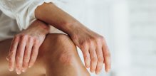 psorijaza i bolesti srca mogu dijeliti slične genetske predispozicije