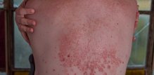 teži oblici psorijaze povećavaju rizik od kardiovaskularnih problema
