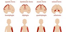 vrste cerebralne paralize