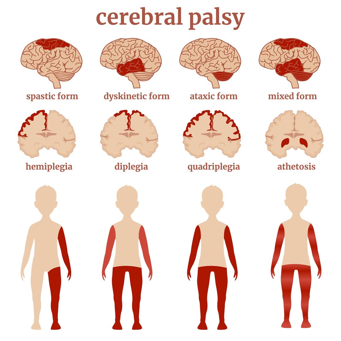 vrste cerebralne paralize