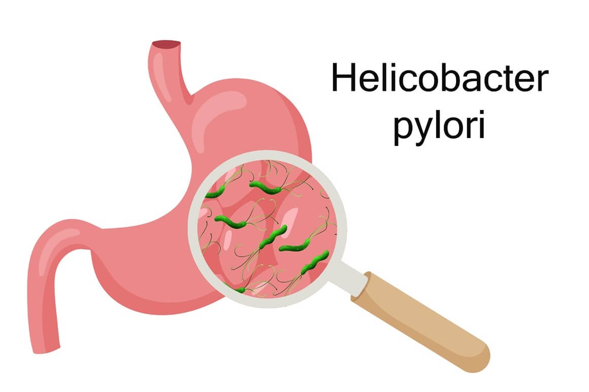 H. pylori je jedna od najčešćih bakterijskih infekcija kod ljudi