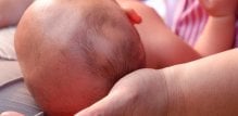 Hematom na glavi bebe nakon poroda