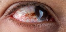 Herpes u oku