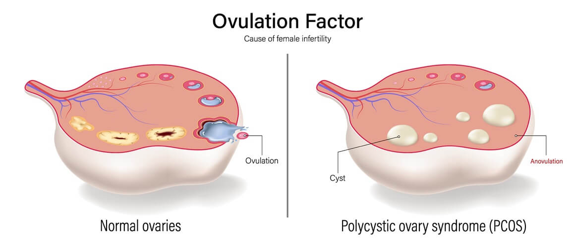 PCOS ima snažnu genetsku komponentu