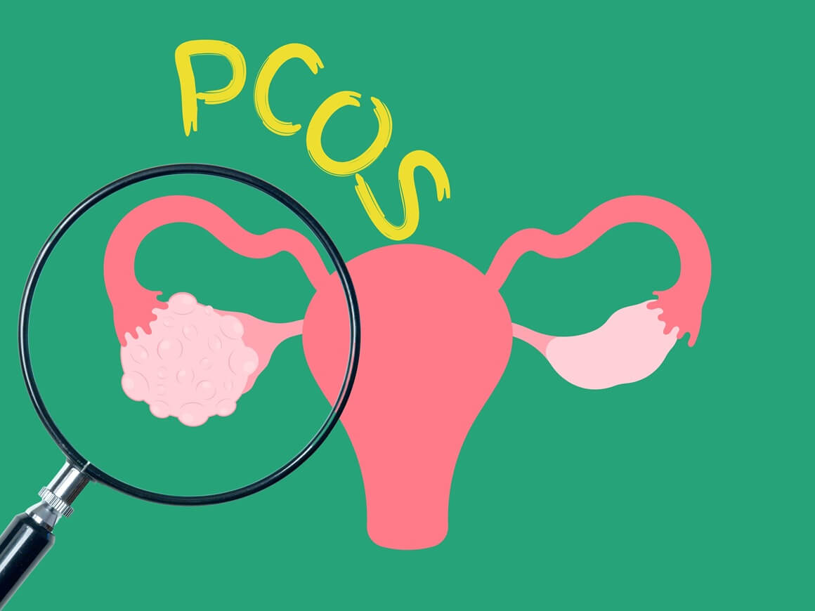 PCOS povećava rizik od raka endometrija