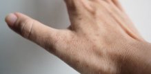 Pjege od sunca se liječe uglavnom iz estetskih razloga