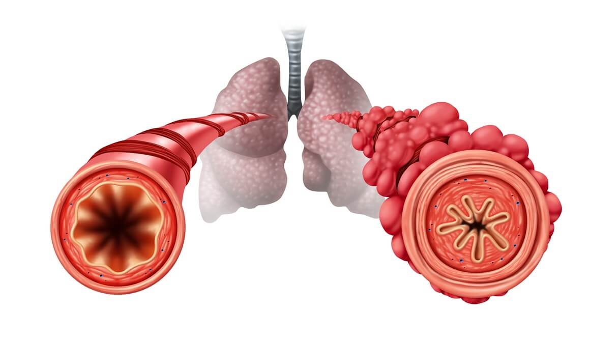 Popcorn pluća je kolokvijalni naziv za bolest bronhiolitis obliterans