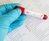 Testiranje na lupus