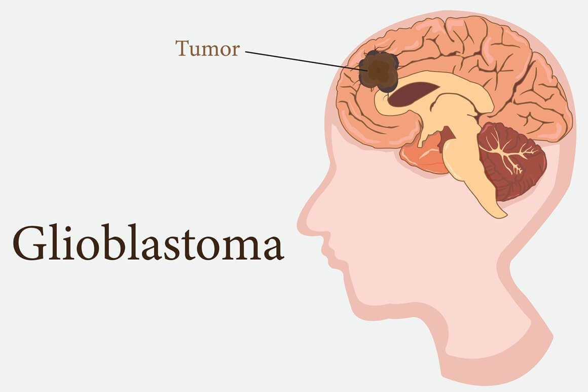 glioblastom