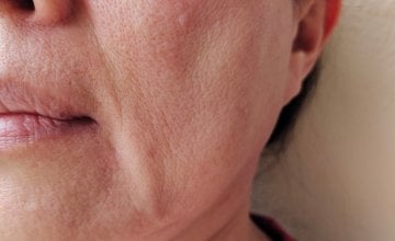 menopauza i suha usta