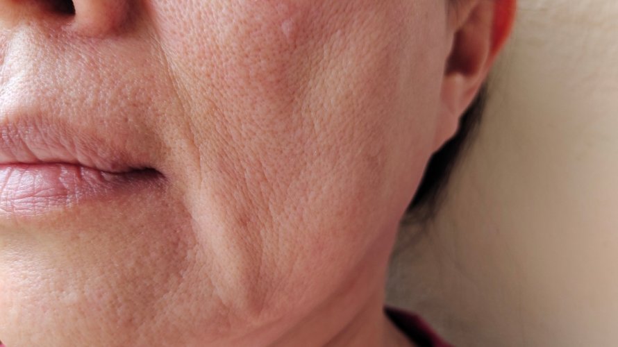 menopauza i suha usta