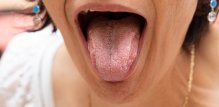 oralna kandidijaza u menopauzi