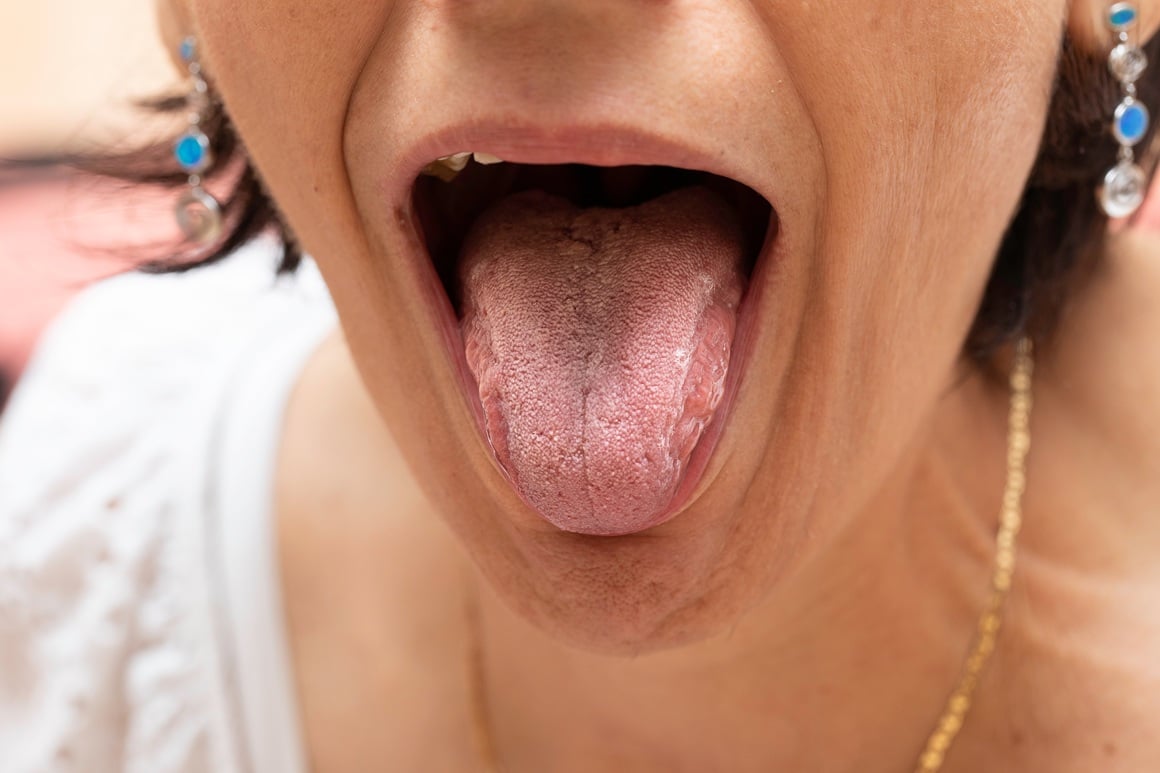 oralna kandidijaza u menopauzi
