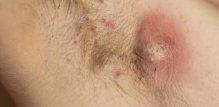Gnojni hidradenitis