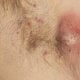 Gnojni hidradenitis