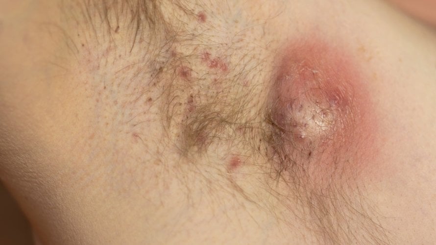 Gnojni hidradenitis