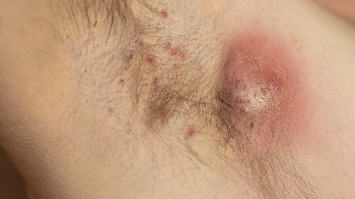 Gnojni hidradenitis