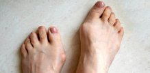 Hallux rigidus Sve o bolnom palcu i mogućem liječenju