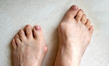 Hallux rigidus Sve o bolnom palcu i mogućem liječenju