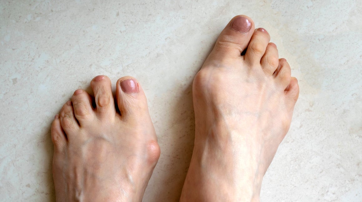 Hallux rigidus Sve o bolnom palcu i mogućem liječenju